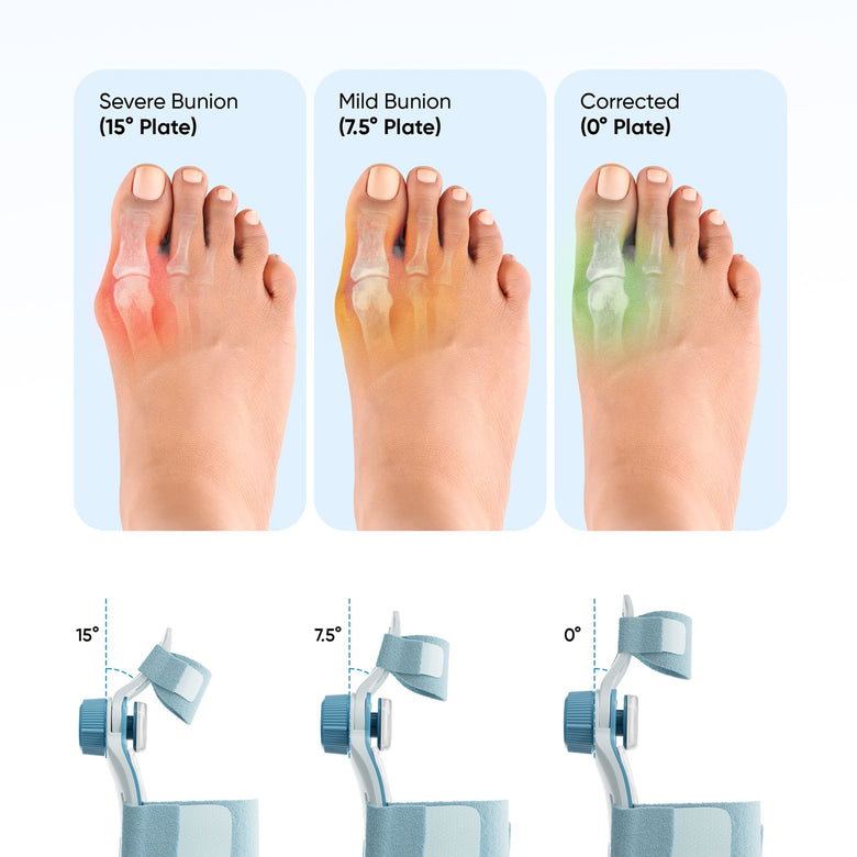 Corrects Bunions Gradually and Effectively